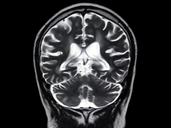 特殊磁共振成像显示，新冠肺炎后大脑出现明显异常