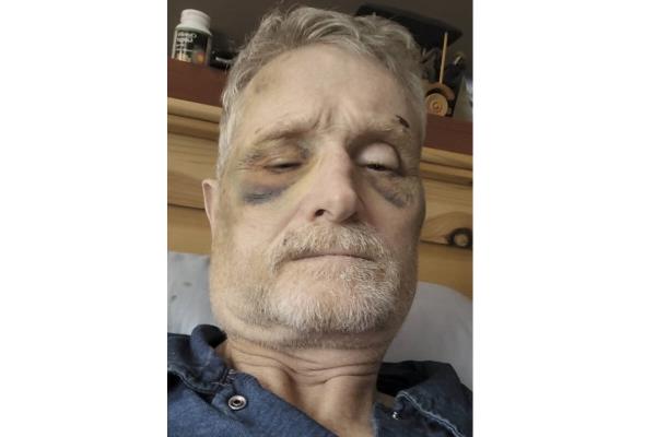 尼尔森男子上传了脸部受伤的视频，声称遭到警察袭击